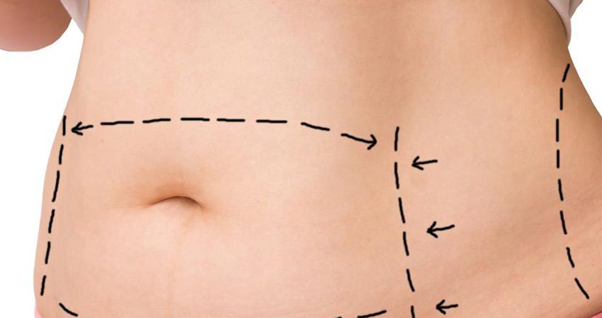 Como é feita a abdominoplastia? - Dr. Alexandre Meira