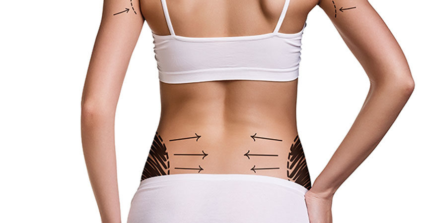 Abdominoplastia com lipo: como é feita, resultados e pós-operatório - Tua  Saúde